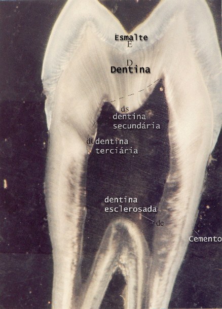 Dente - corte por desgaste em luz refletida na lupa