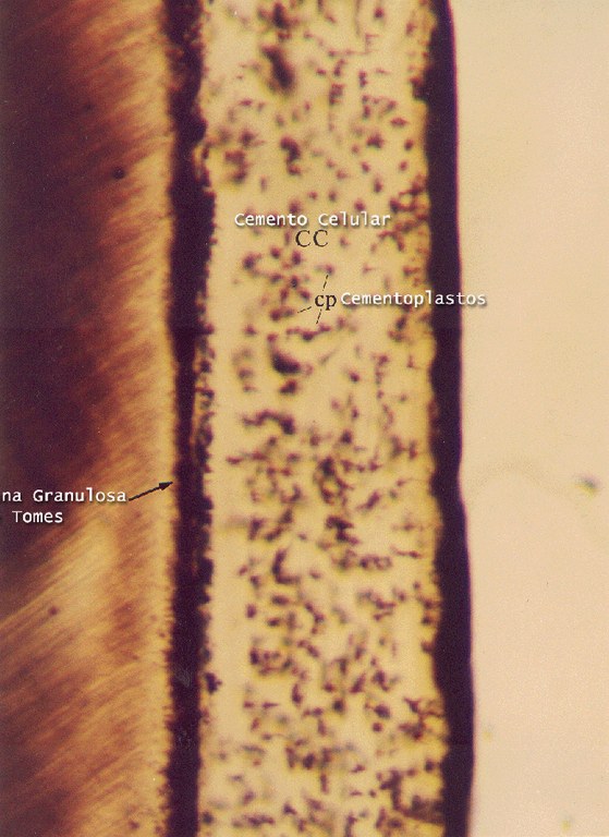 Cemento celular com cementoplastos